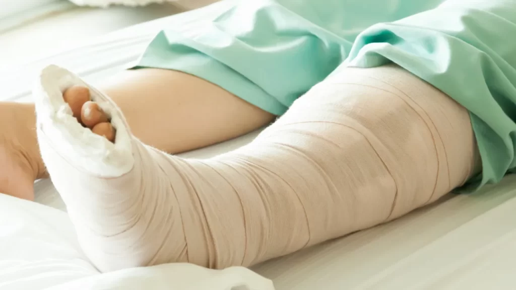 How to File a Complaint Against Bone Fractures in Accident - Geeks ...